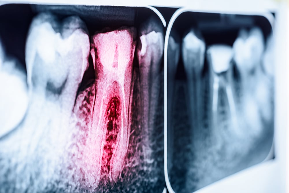root-canal-therapy-image